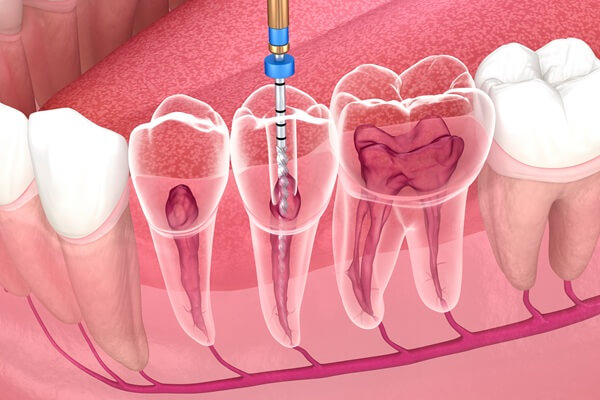 what-expect-during-treatment-urban-dental