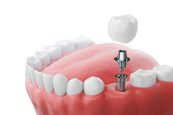 what-to-expect-during-treatment-dental-implants