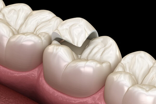 what-to-expect-inlays-onlays